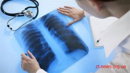 На Житомирщині затвердили стратегію, за якою до 2020 року планується зниження захворюваності на туберкульоз